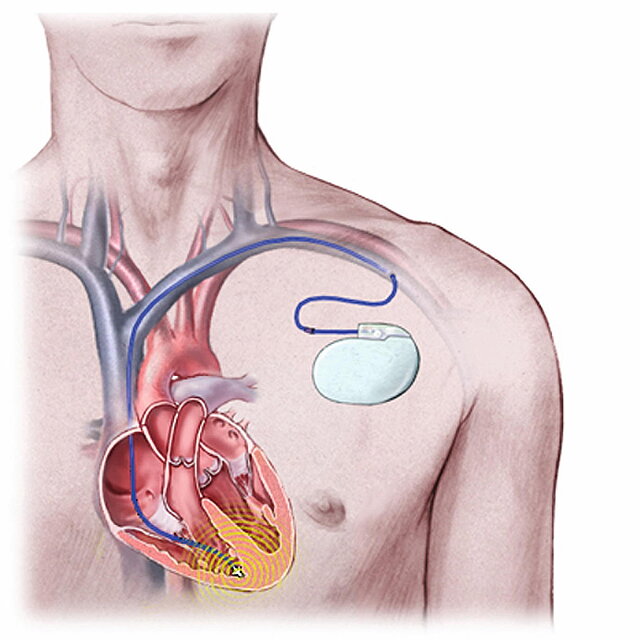 Eine Illustration der Funktionsweise eines Defibrillators im menschlichen Körper.